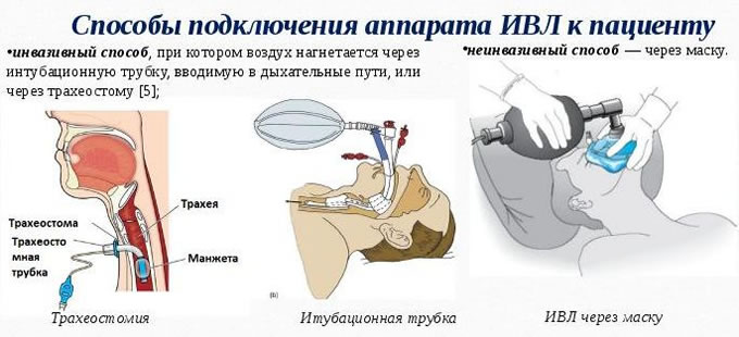 ИВЛ